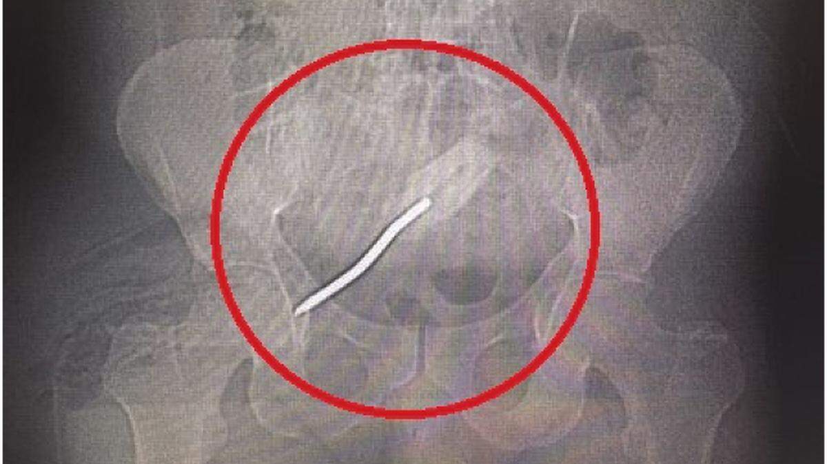 Doctors at Kendall Regional Hospital released a report detailing how a Miami man had to have a screwdriver surgically removed from his rectum.