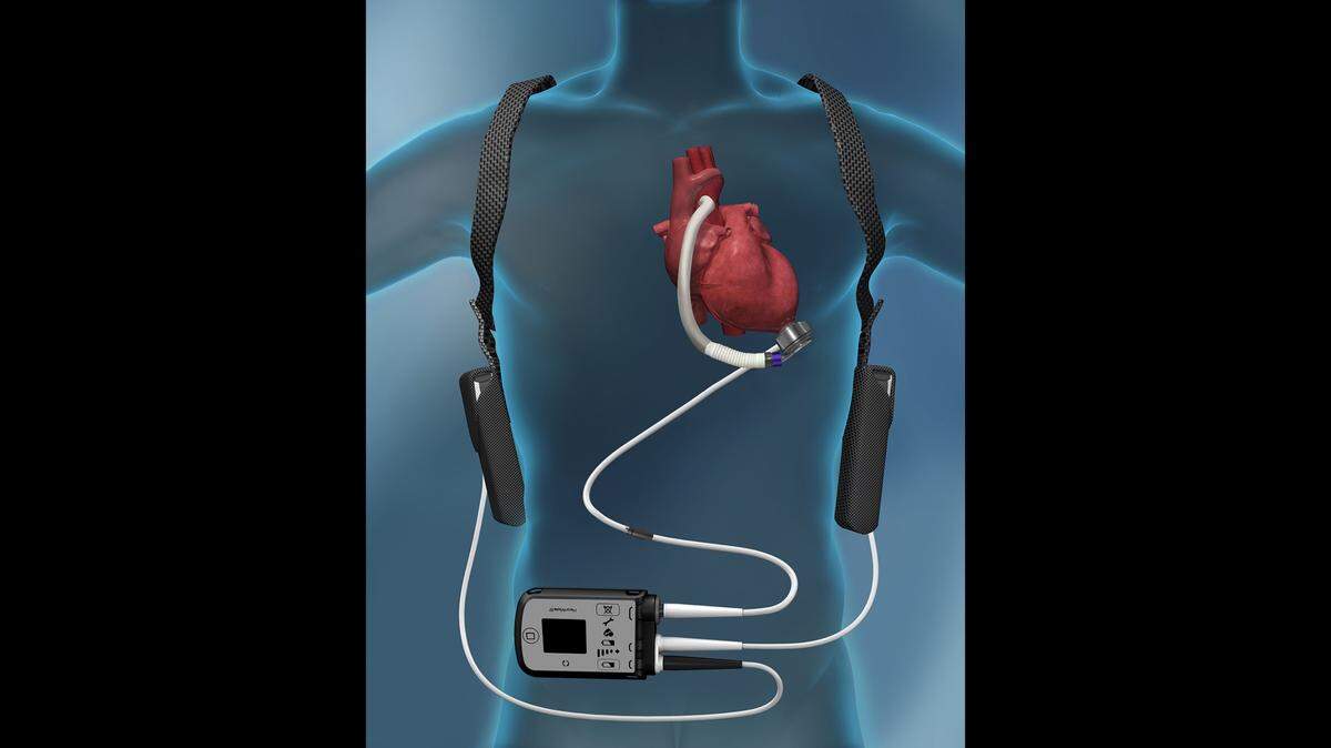 Cleveland Clinic Weston’s Dr. Cedric Sheffield said that the most common left ventricular assist device being used right now for adults is Abbott’s HeartMate 3, above.
