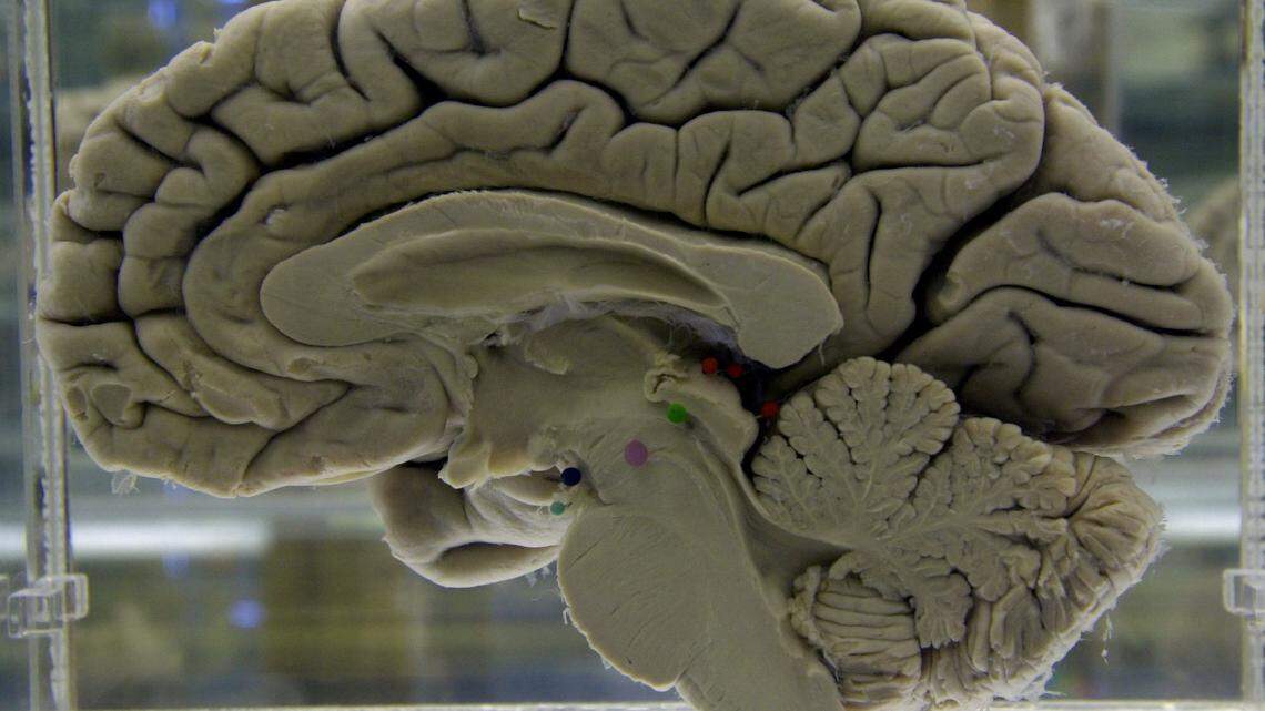 This 2003 photo shows a section of a preserved human brain on display at the Museum of Neuroanatomy at the University at Buffalo. A study that followed more than 14,000 adults over 25 years found that just one head injury could raise someone’s chances of developing dementia later in life.