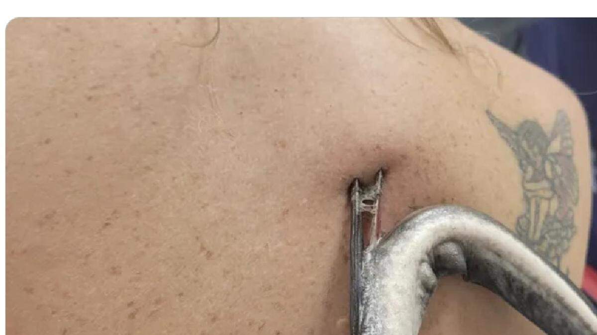 Una mujer de la Florida fue atacada por una mantarraya en Bahia Beach, en Ruskin, cerca de Tampa Bay, y acabó en el hospital con la púa clavada en la espalda