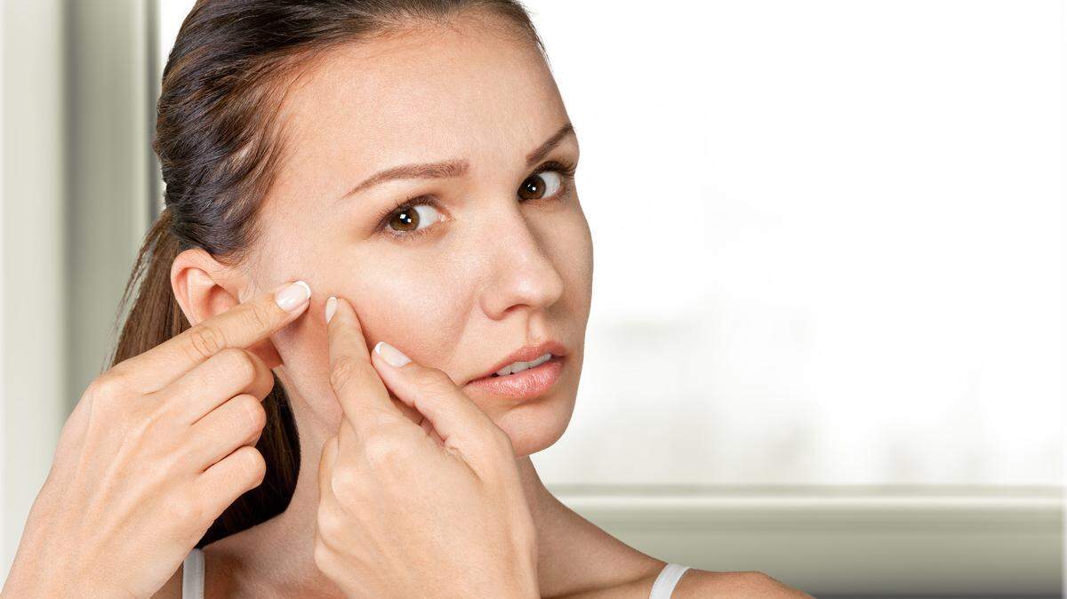 The FDA recently approved Winlevi, a new prescription for treating hormonal acne. If you have acne but don’t want to take antibiotics, Accutane, or birth control, this may be your option. 