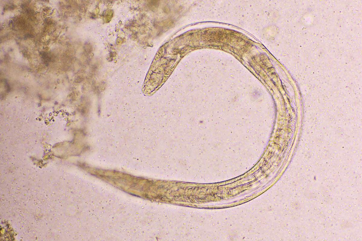Strongyloides are a parasitic roundworm and were spread to the man through a donated kidney.