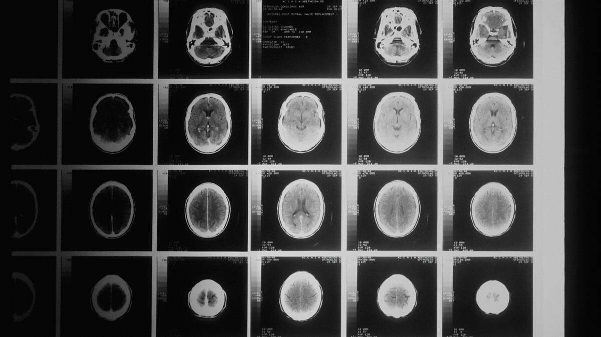 Hormonal drugs used to treat gynecological conditions and in injectable birth controls have been linked to an increased risk of developing a type of non-cancerous brain tumor, a new study says.