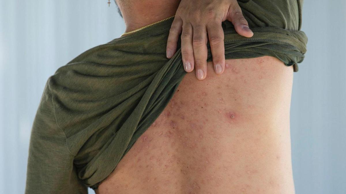 Hollywood resident, Victor Infante, 35, shows two blisters or pimples on his back caused by the Monkeypox virus on Wednesday, July 20, 2022. A rash can also be seen on his back that was caused by an allergic reaction to medication from a previous accident unrelated to Monkeypox.