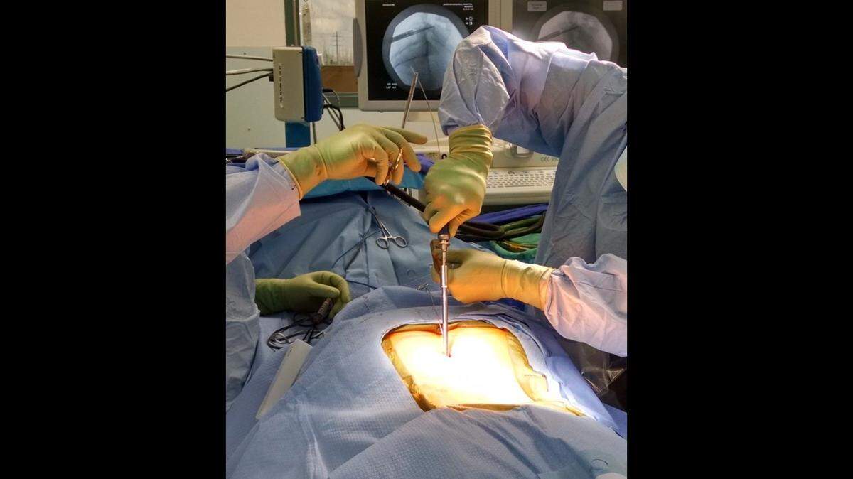 University of Miami neurosurgery team performs a pars fracture repair surgery using tiny incisions made on the back.
