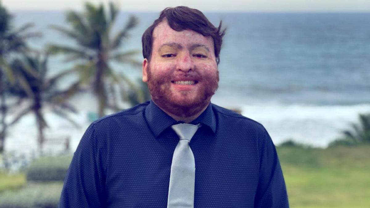 Alexis Joel Hernández, a 25-year-old Puerto Rican man, suffered severe burns on most of his body after an explosion in his apartment in 2019.