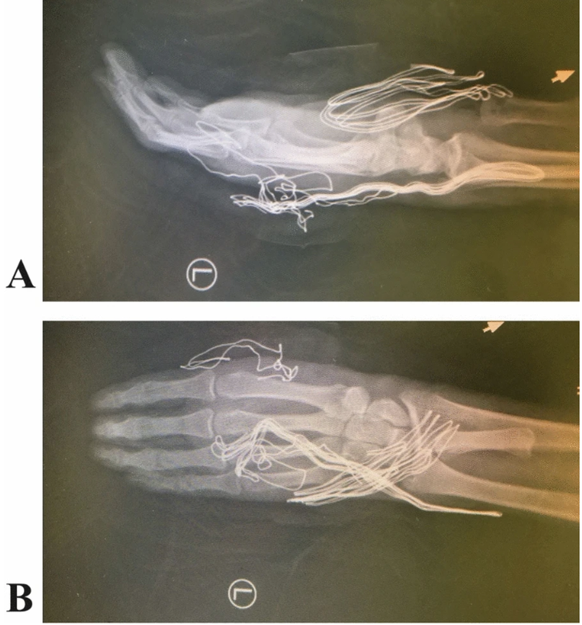The bone of the thumb was “banked” in the man’s arm, appearing on X-rays just below the wrist.