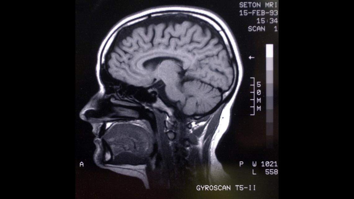 In this stock photo, Magnetic Resonance Imaging of a human head is displayed with an exhibit on the history of imaging of the brain at the Museum of Neuroanatomy at the University at Buffalo in New York. Officials are investigating after 100 former students and staff of a New Jersey high school developed brain tumors.