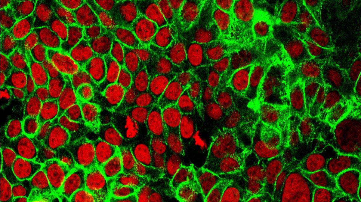 This updated microscope image provided by the National Institutes of Health shows human colon cancer cells with the cell nuclei stained red.