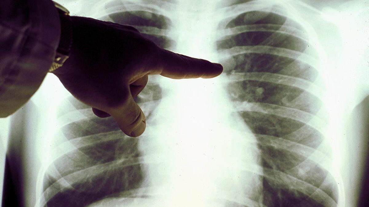 Researchers found a bone switch that could stop osteoporosis before a break happens.