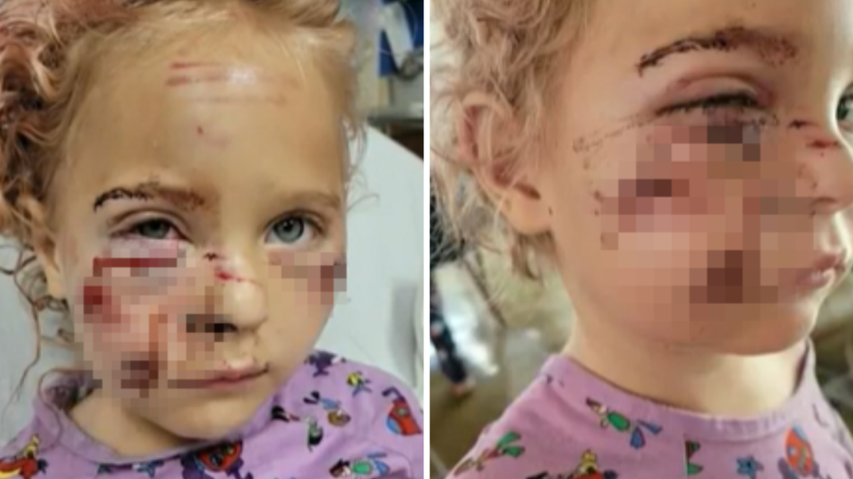 A 5-year-old girl is slowly recovering after a dog bit her in the face several times in Fort Lauderdale on Feb. 7, 2023.