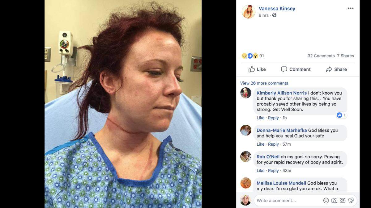 Vanessa Ursini says she was attacked while walking her dog on a Denver, Colorado trail. Police say a suspect has been arrested in connection with the assault.