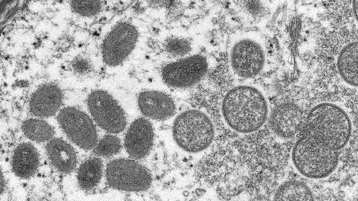 Health officials have confirmed a case of monkeypox in the U.S. after a traveler returned to the country from Canada.