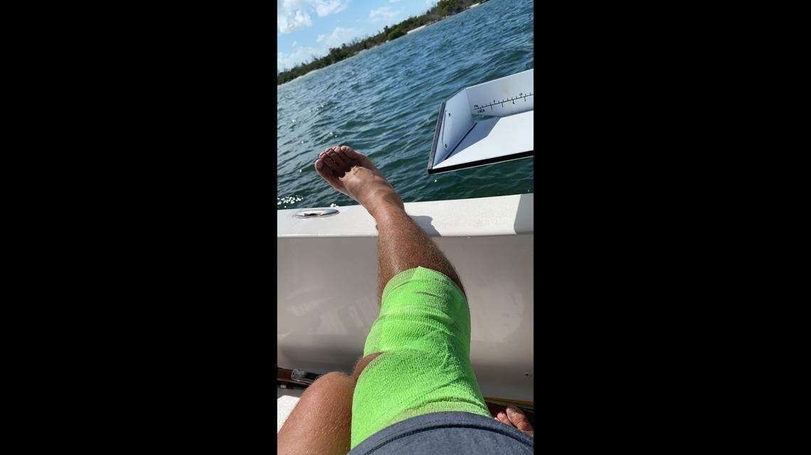 Green bandages are wrapped around the leg of Justin Stuller, from Estero, Florida. A lemon shark bit him while he was diving for lobster on Wednesday, July 29, 2020.