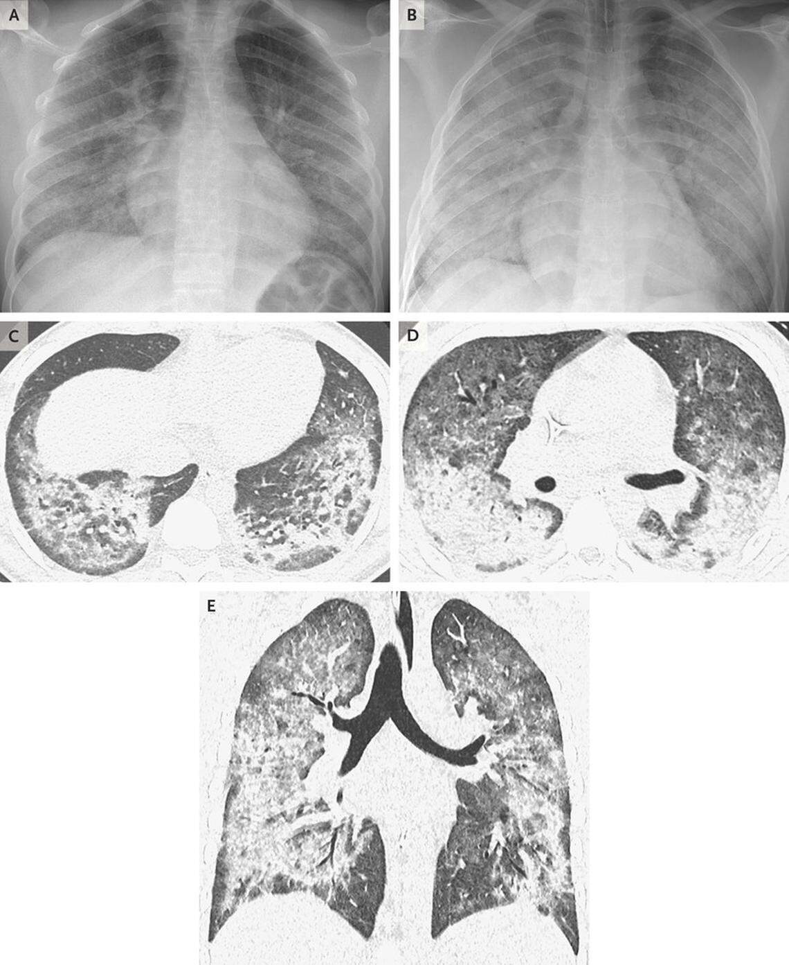 Chest radiographs and high-resolution imaging in a 17-year-old male patient with diffuse lung disease.