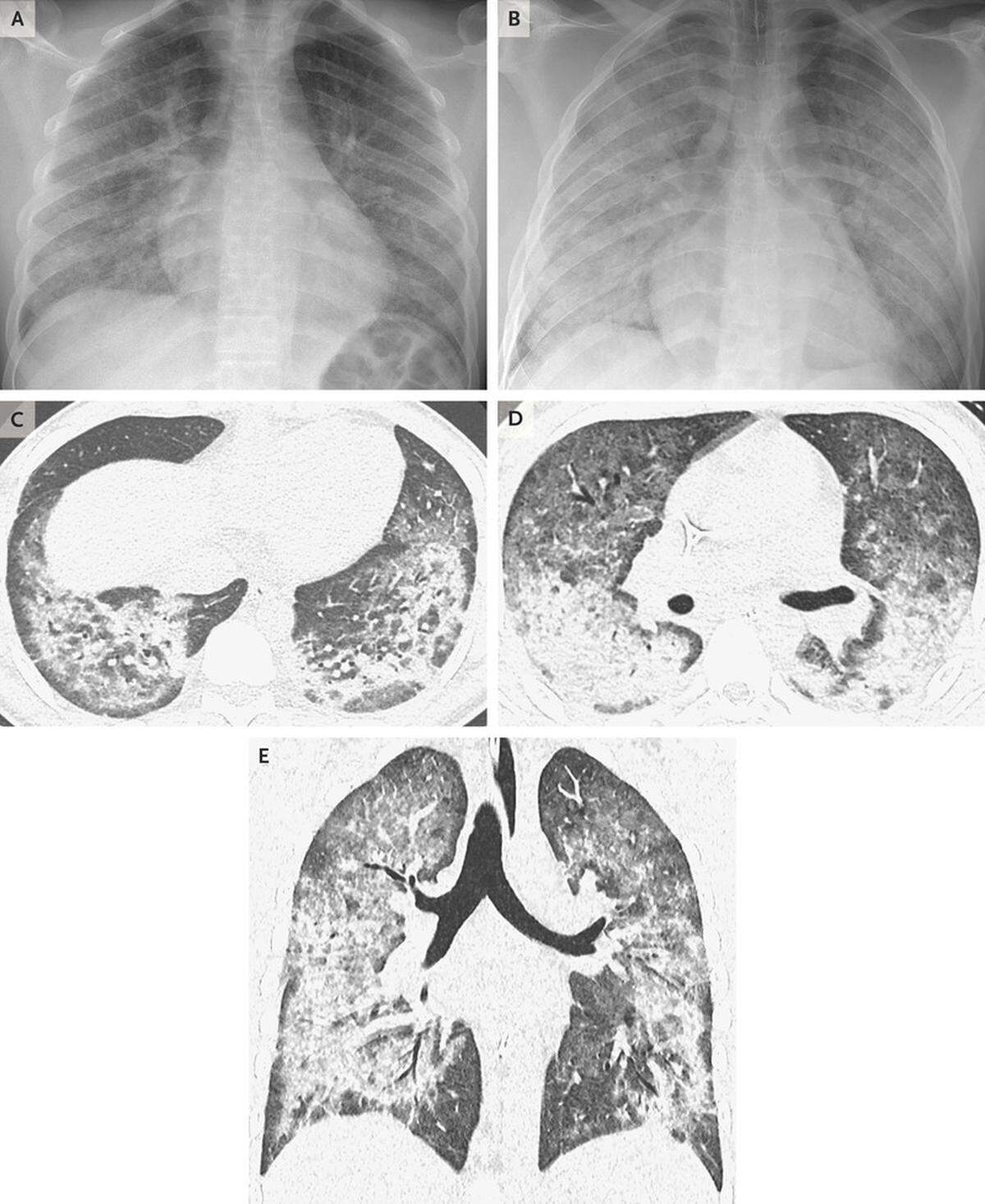 Chest radiographs and high-resolution imaging in a 17-year-old male patient with diffuse lung disease.