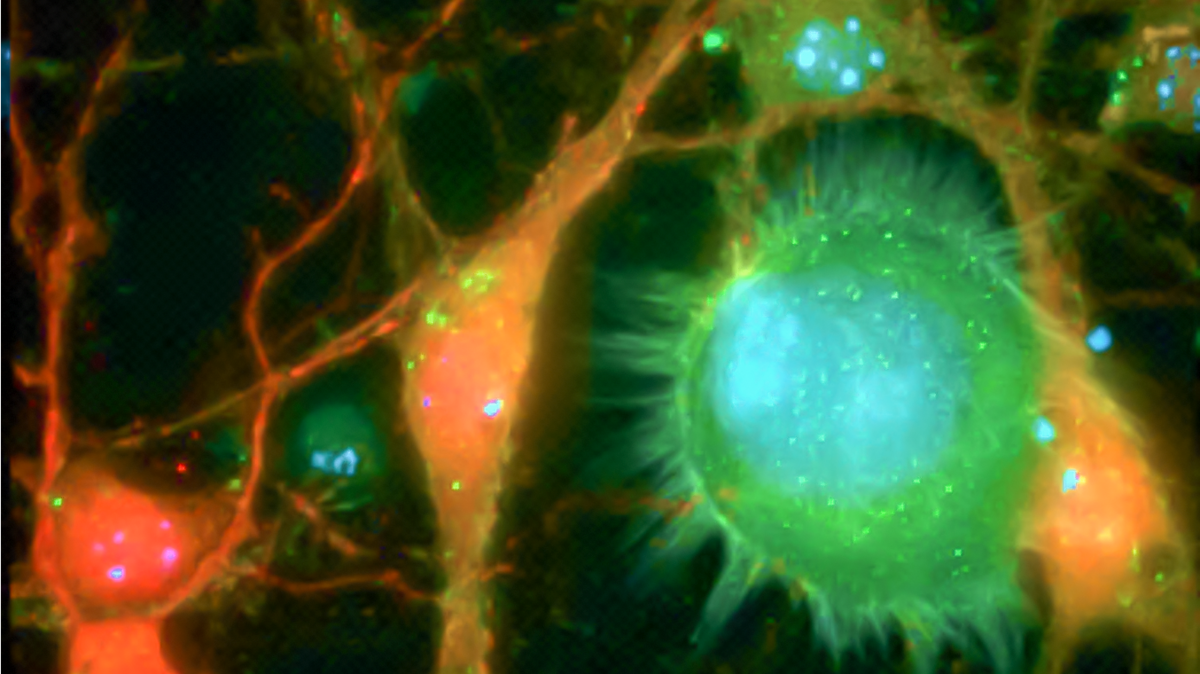 Metastatic breast cancer cells (green) “communicate” with brain cells (red/orange). Researchers from the University of Southern California learned the region where cancer spreads in the brain is dependent on where the cancer first appeared in the body.