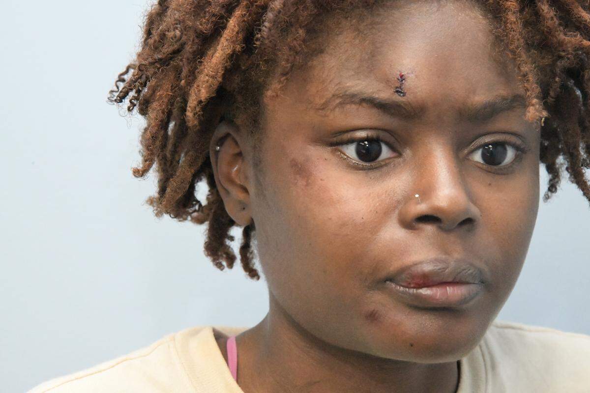 Esther Sanon’s injuries after the April 10, 2023, meet up that ended in a shooting.