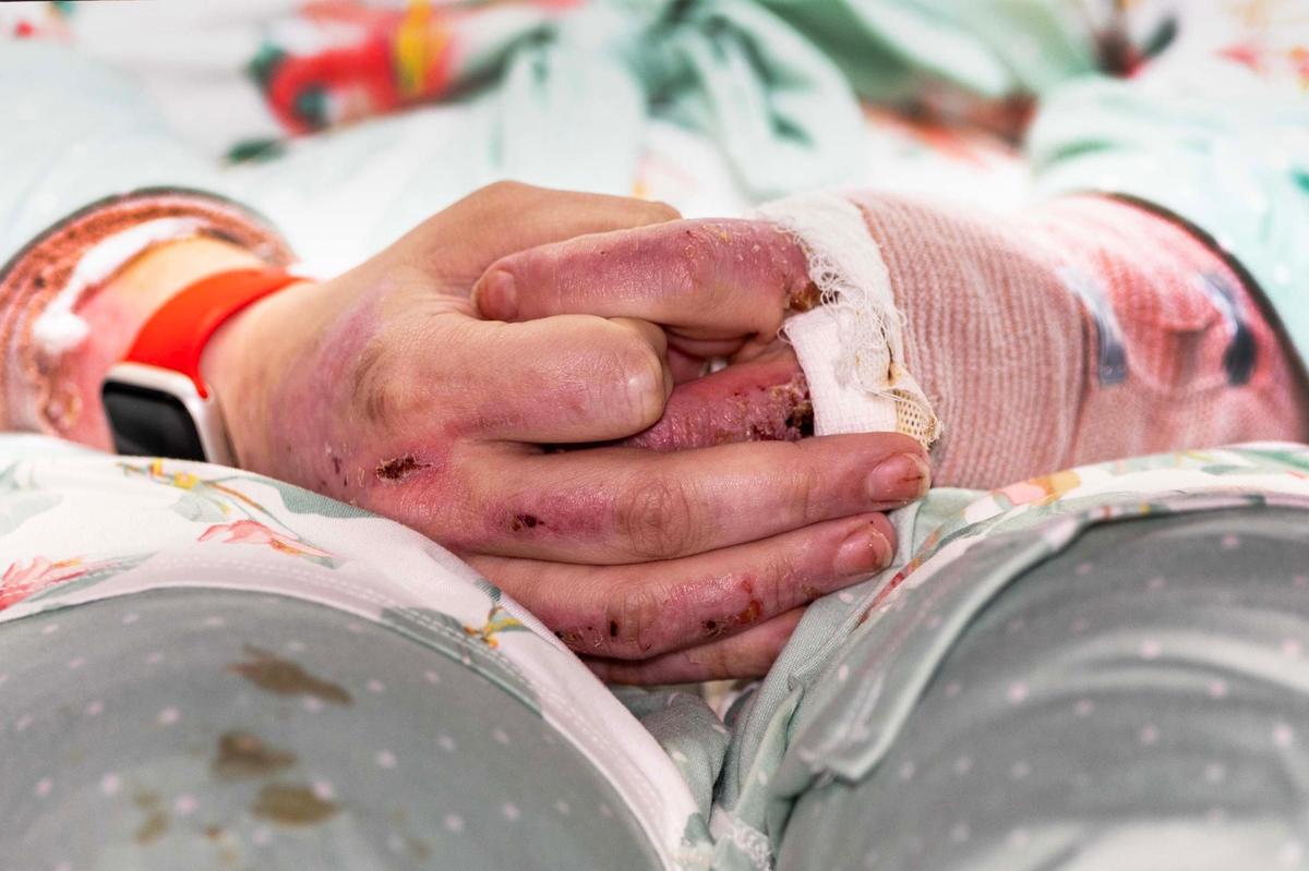The burns on the hands of Cassandra Rivera, who spoke to the media about the Fort Lauderdale boat explosion on Memorial Day, where she and her two young sons were severely burned. She spoke during a press conference at Ryder Trauma Center at Jackson Memorial Hospital on Wednesday, June 11, 2025, in Miami, where the family has been treated. The boat’s operator was killed.