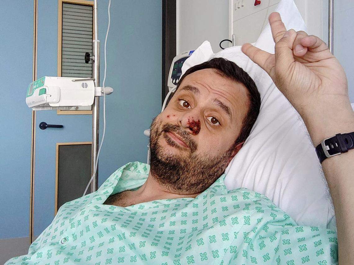 Harun Tulunay’s monkeypox lesion on his nose grew in size.