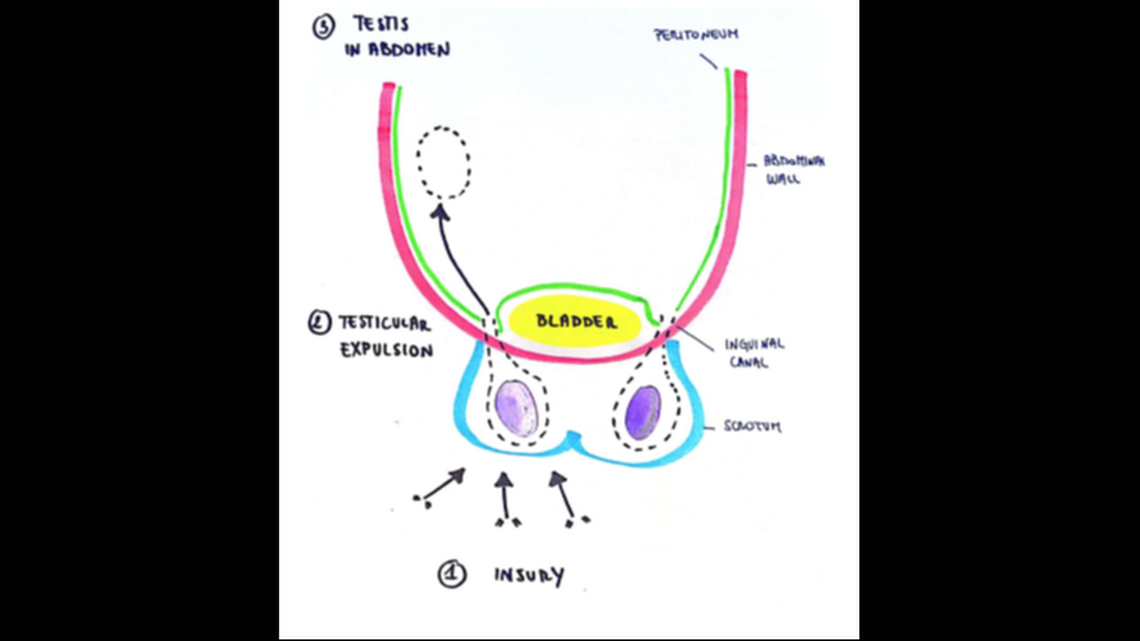 The injury is called testicular expulsion, when a free floating testicle is pushed through the inguinal canal of the pelvis and into the body.