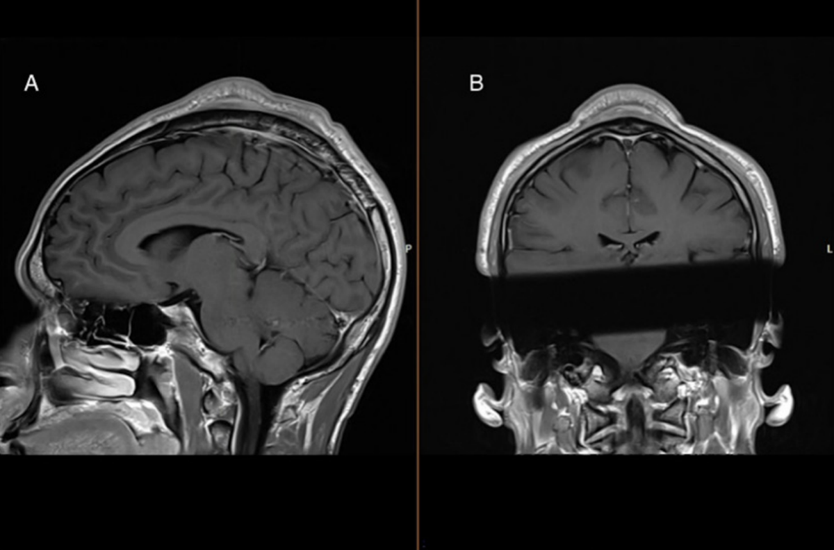 The tumor was outside of the skull, but doctors worried it could be cancerous.