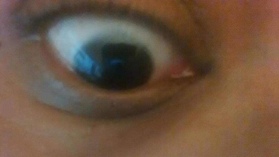 South Florida drug company recalls 3 eye drugs that might not be sterile