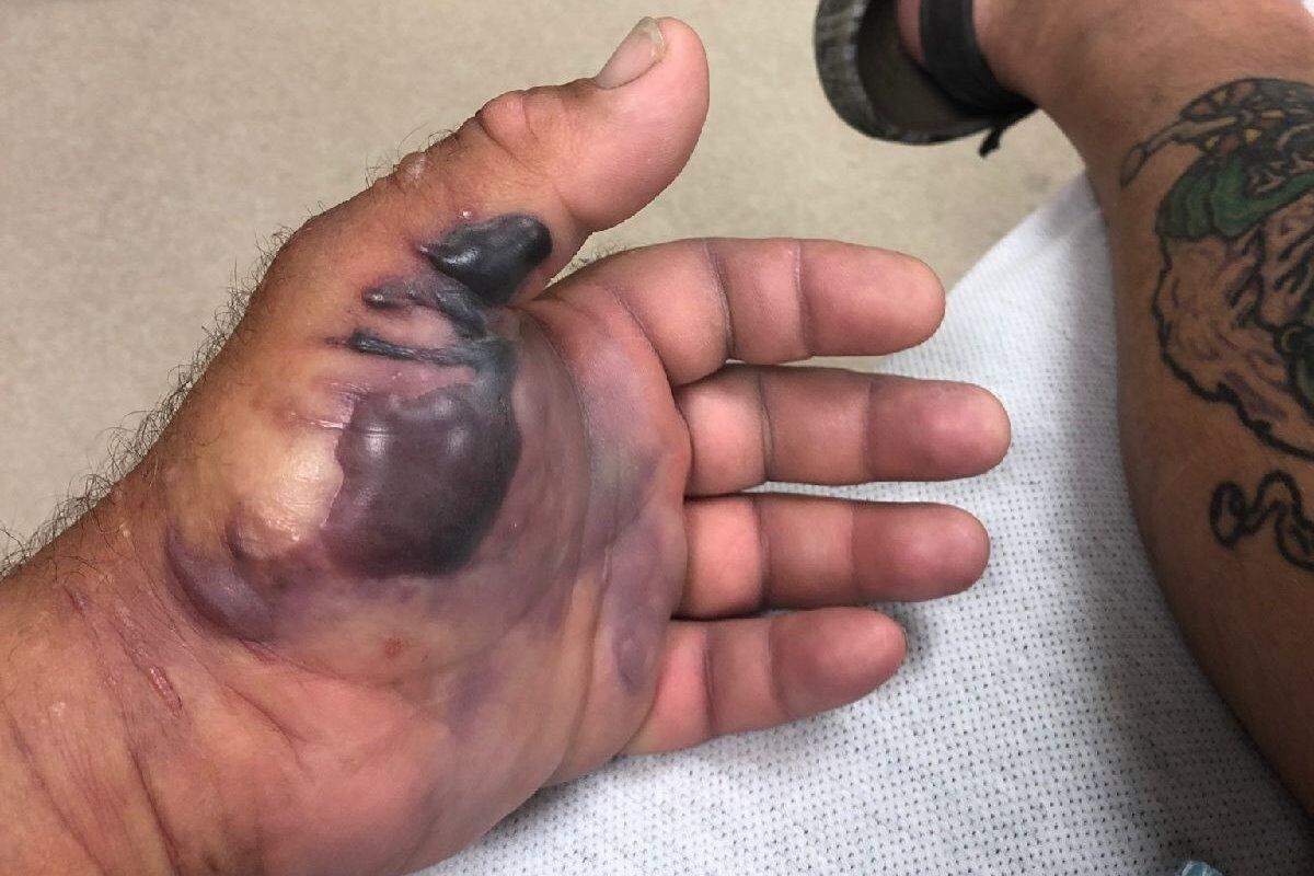 Mike Walton’s hand began to blister with black bubbles, a sign of necrotizing fasciitis on April 14, 2019.