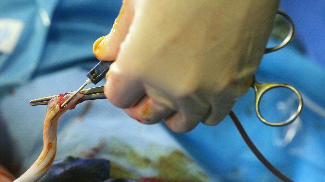 An instrument is used to take blood from the umbilical cord of a newborn.