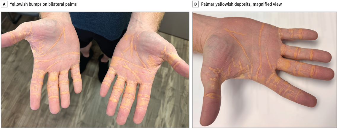 Yellowish bumps and nodules appeared on the man’s palms, soles and elbows after 8 months on the carnivore diet, doctors said.