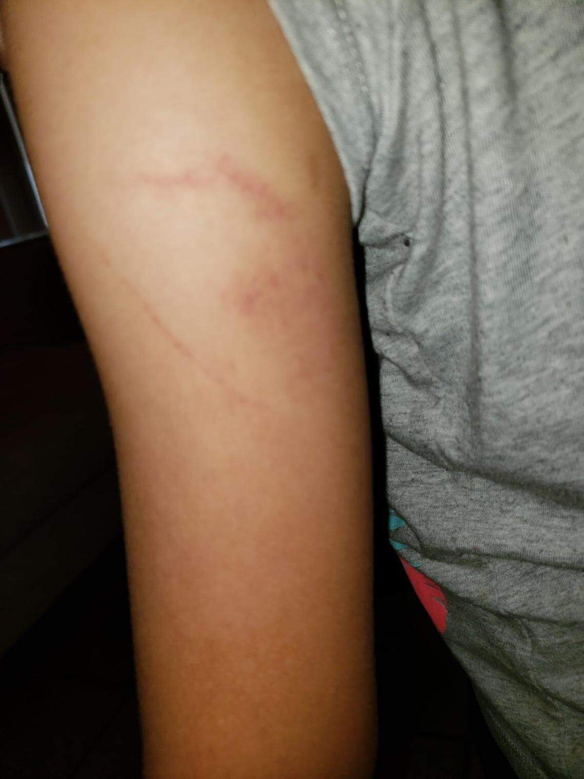 Suspicious bruises on the arm of the 6-year-old daughter of Gisela Lopez. The mother believes it was caused by one of the employees at Pasadena Lakes Elementary in Pembroke Pines.