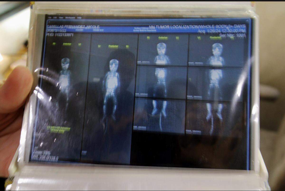 A scan shows the spread of Nicole Casellas’ metastatic neuroblastoma. The bright white areas on the scan indicate where the cancer is present in her body. 