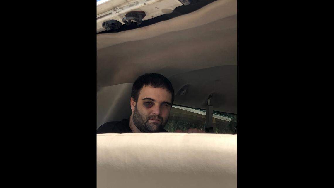 The black eye that, according to caregivers, Caleb Walker gave himself.