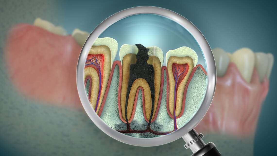 A lab-made gel that helps rebuild tooth enamel could reshape how we treat erosion and sensitive teeth