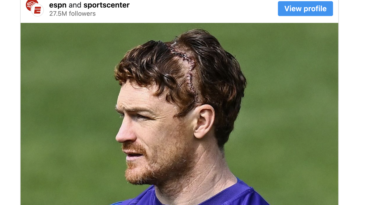 Sports fans shared their outrage after images of Gary Rohan with staples in his head went viral.