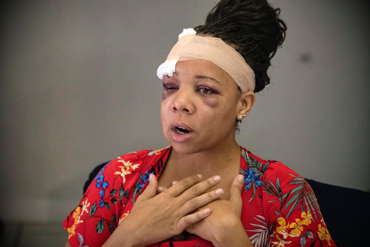 LaToya Ratlieff talks about her experience on Tuesday, June 2, 2020. after police shot her in the face with a foam projectile at an anti-police brutality protest in Fort Lauderdale. Ratlieff was choking from tear gas and trying to leave the area when she was shot on Sunday.