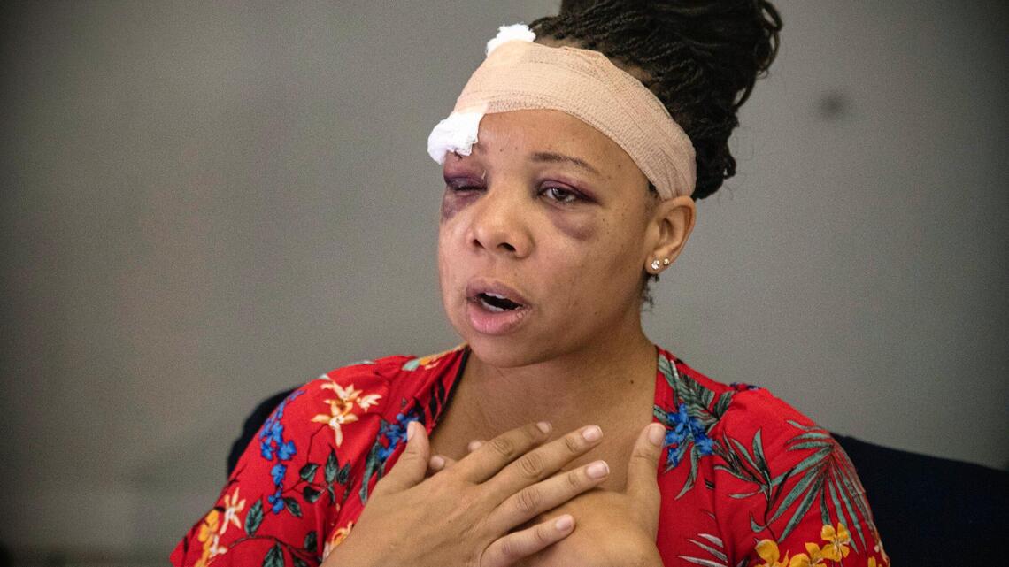 Broward leaders want accountability for officer who shot protester with foam bullet