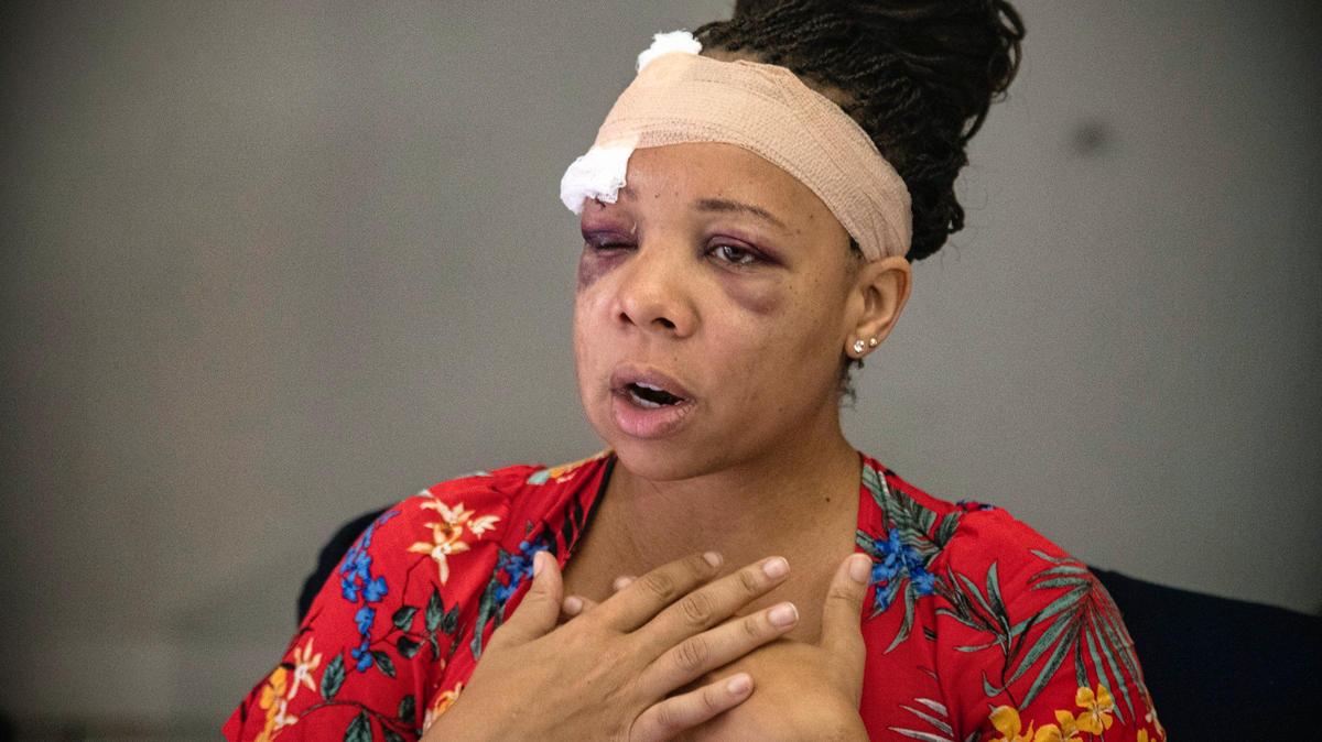 LaToya Ratlieff habla de su experiencia después que la Policía le disparó en la cara con un proyectil de goma en una protesta de Black Lives Matter en Fort Lauderdale. Ratlieff se estaba ahogando por los gases lacrimógenos e intentaba abandonar la zona cuando le dispararon.