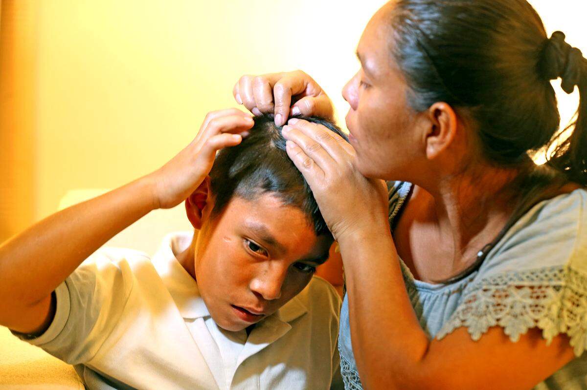 Geremy, an 11-year-old boy, and his mother, Otila Asig-Putul, looks at a scar from an injury he incurred after being separated for two months at the U.S.-Mexico border as they tried to enter the country illegally in May, July 16, 2018. The family is now suing the U.S. government after they say the boy was bullied in the Chicago shelter. HIs injuries were so bad that his head was “cracked open” and he needed staples.