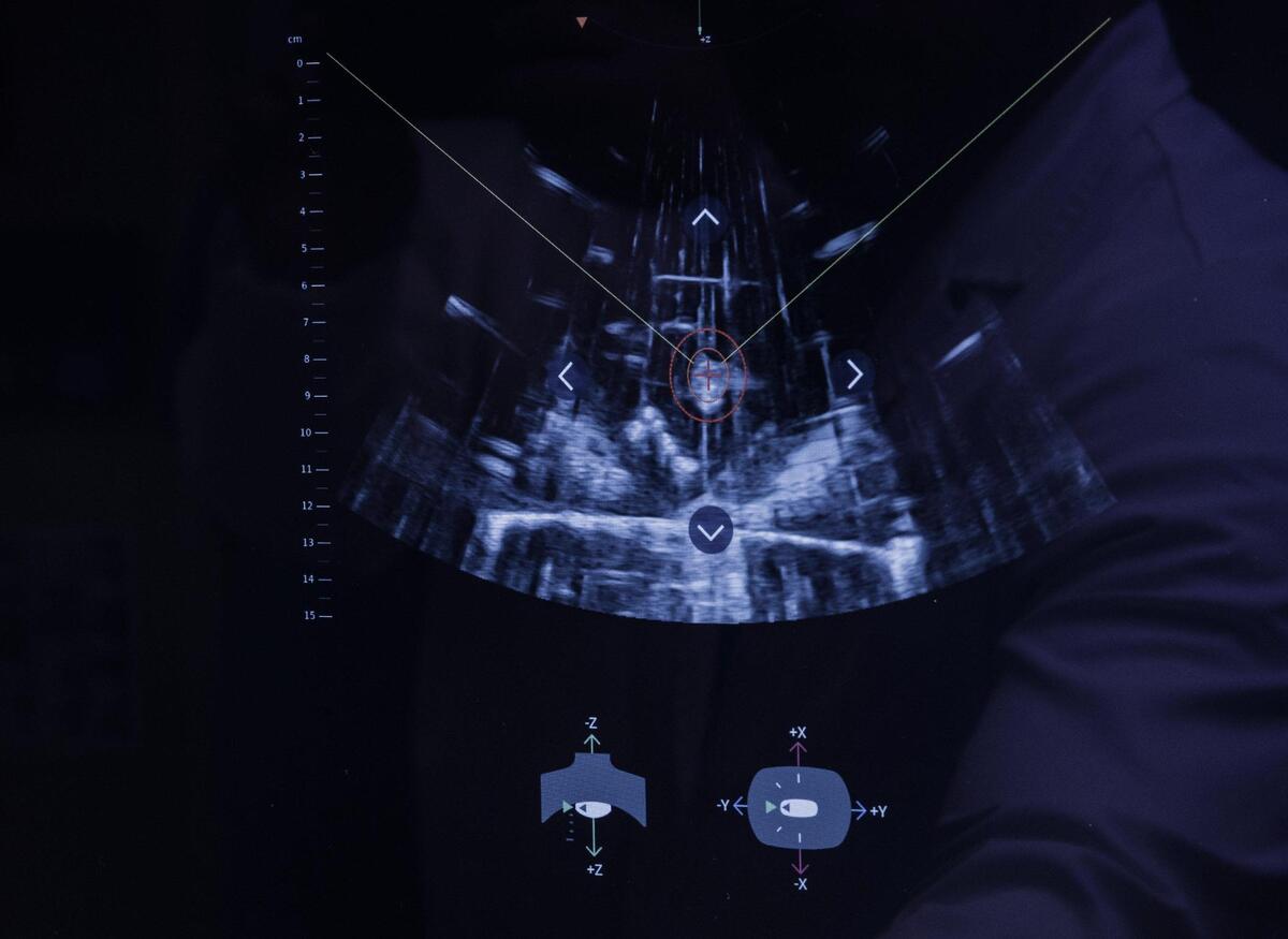 View of a “Cloud Bubble” created by the frequency ultrasound that is ablating a liver tumor during a procedure using the Edison Histotripsy System medical device that targets liver tumors in a human body, as part of a demonstration at the Memorial Hospital West, in Pembroke Pines, on Thursday June 12, 2025.
