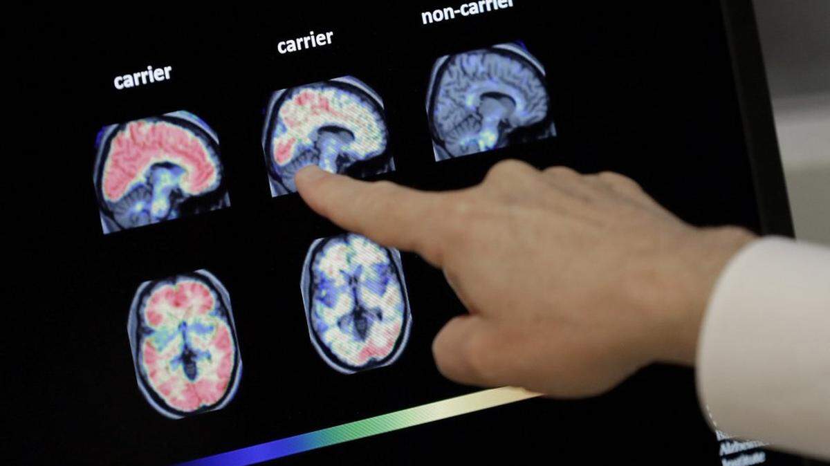 Despite questionable results, including brain bleeds, FDA fast-tracked approval of Leqembi for Alzheimer’s patients.