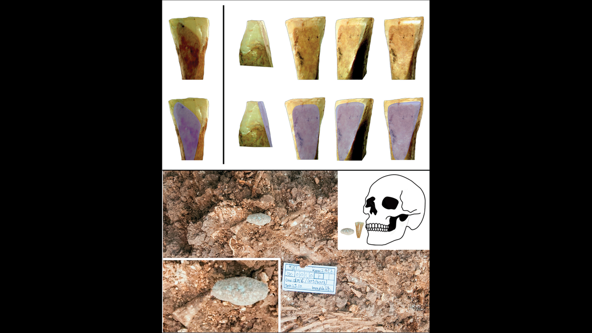 Some of the skulls had teeth that were altered, suggesting the person had used a labret for a significant portion of their life, the researchers said.
