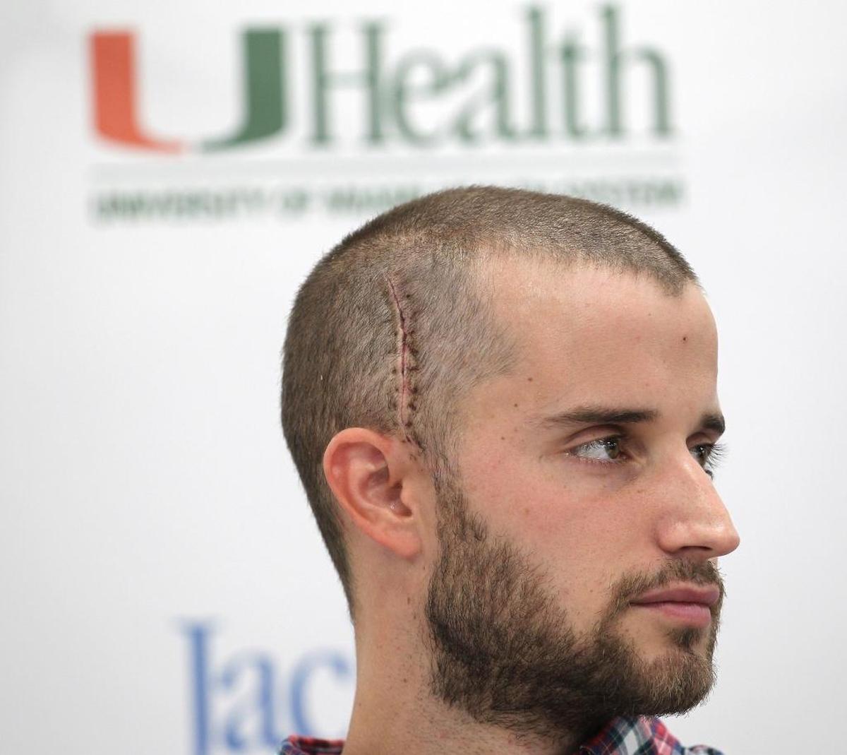 A scar is all that remains for 28-year-old Special Ops Air Force trainee, Paul Casas. On Tuesday, June 6, 2017, University of Miami Health System and Jackson Memorial Hospital held a press conference regarding UM neurosurgeon Dr. Jacques J. Morcos’ successful double artery bypass on Casas’ brain. Casas was diagnosed with a rare brain condition known as Moyamoya disease.