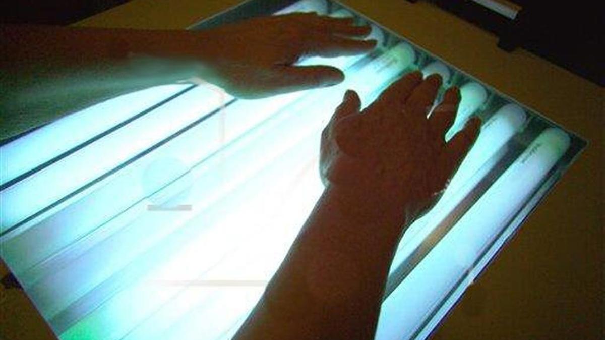 A patient with psoriasis is treated with ultraviolet light at the health resort Bad Salzuflen in Germany. Treatment with ultraviolet light can ease the symptoms of psoriasis.