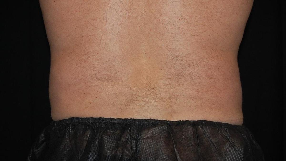 No more love handles after Dr. Carlos Wolf underwent Cool Sculpting, a treatment that freezes and kills fat cells.