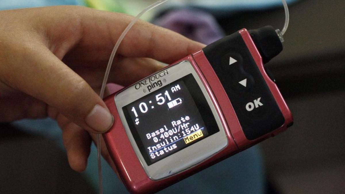 An insulin pump helps regulate a person’s blood sugar when insulin dosage instructions are entered into the pump’s small computer.