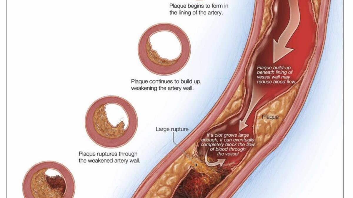 A representation of atherosclerosis, the narrowing of the arteries, which can lead to impotence, itself a possible warning sign of heart disease.