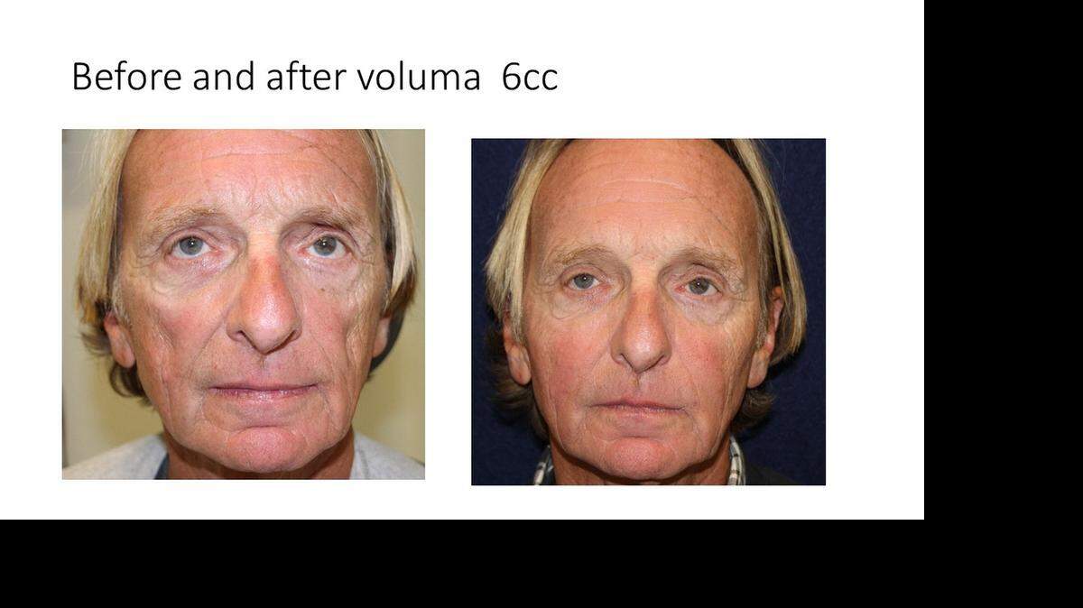 
Before and after: Man at right after receving injections of Juvederm Voluma, an injectable gel to add volume to your cheek area.
