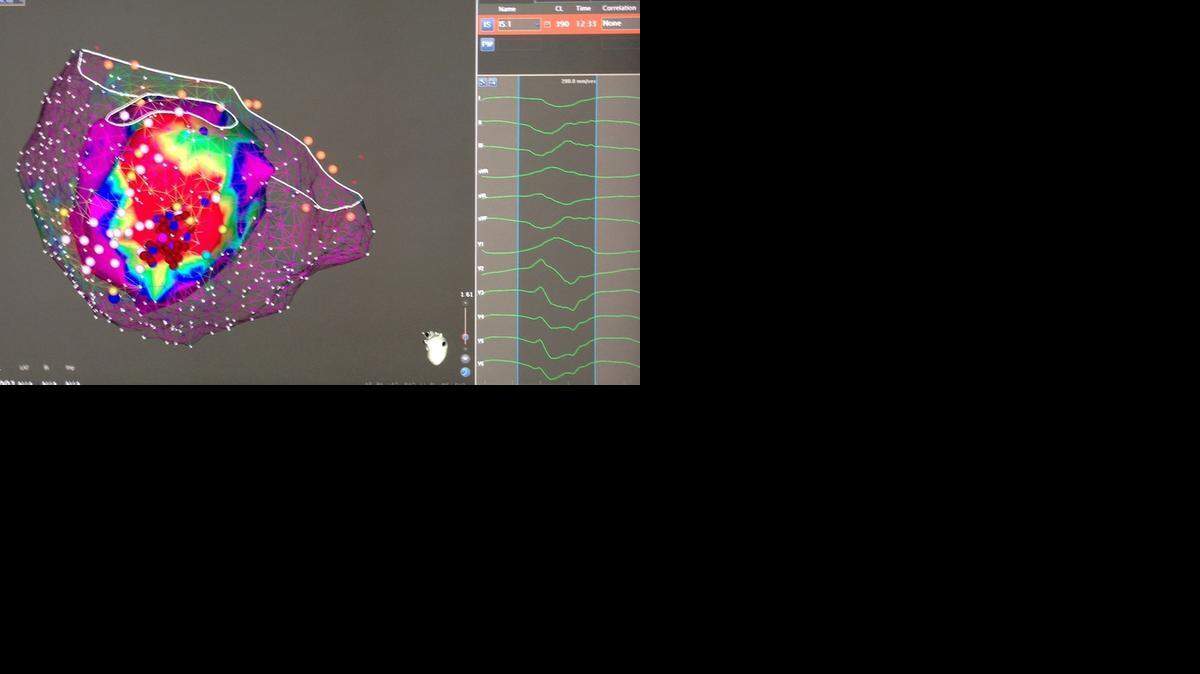 
3D imaging of a heart showing irregular heartbeats.

