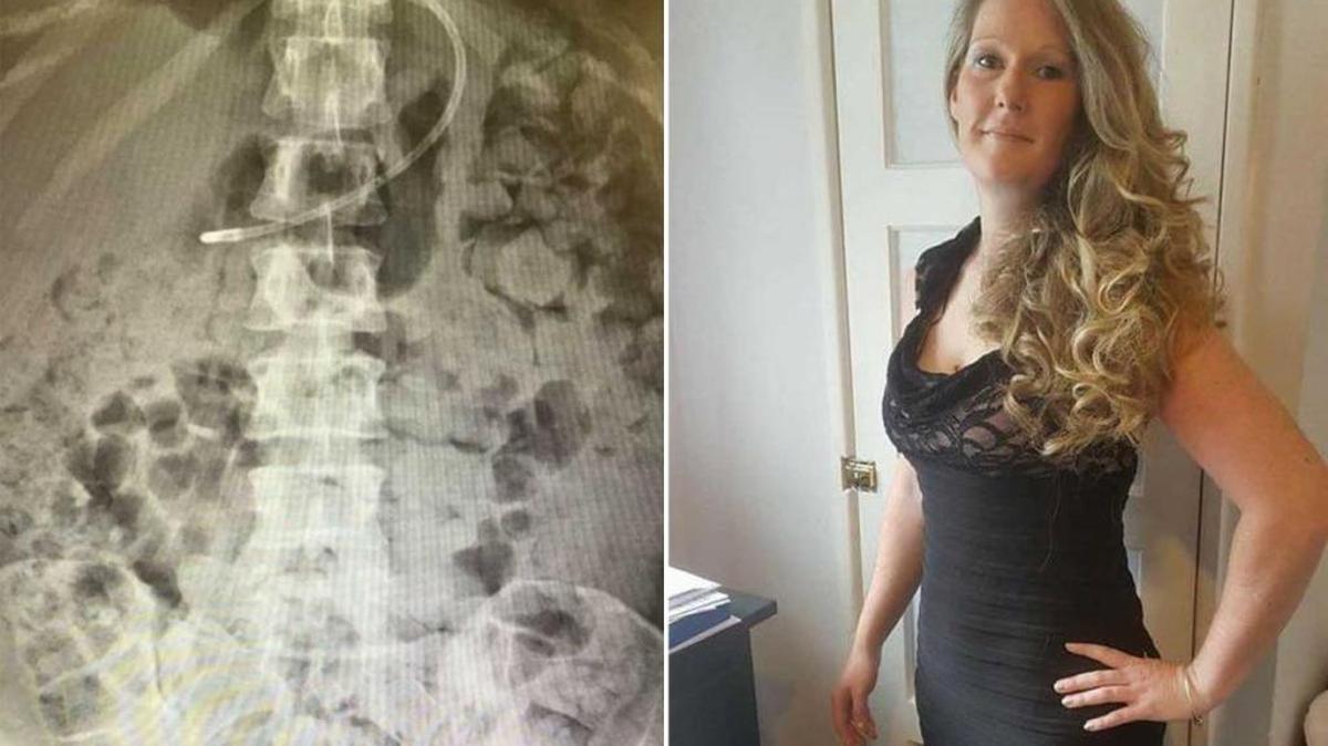 X Ray for Kelly Yeoman